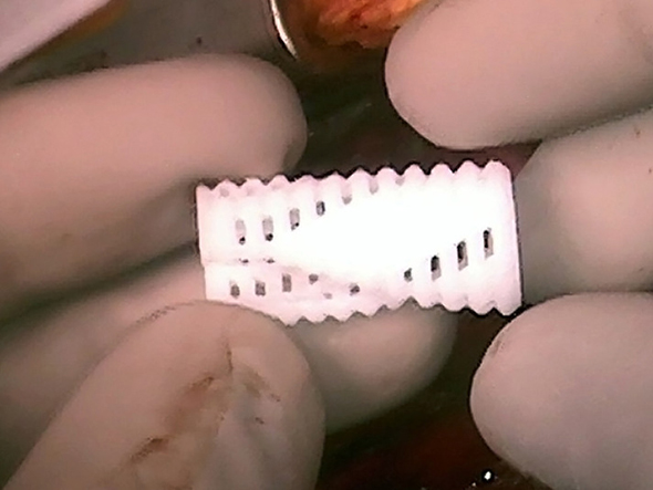 3D printed airway splint