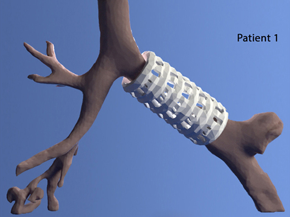 3D printed airway splint