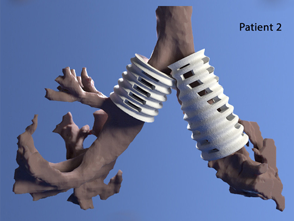 3D printed airway splint
