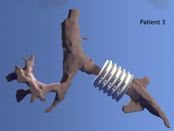 3D printed airway splint