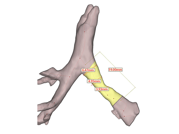 3D printed airway splint